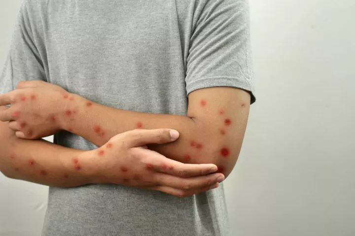 Αυξητική τάση για τα κρούσματα της νόσου Mpox - Ποια τα συμπτώματα