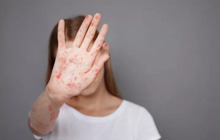 Συναγερμός στις ΗΠΑ: Η χώρα αντιμέτωπη με τη μεγαλύτερη επιδημία ιλαράς από το 2000 (vid)